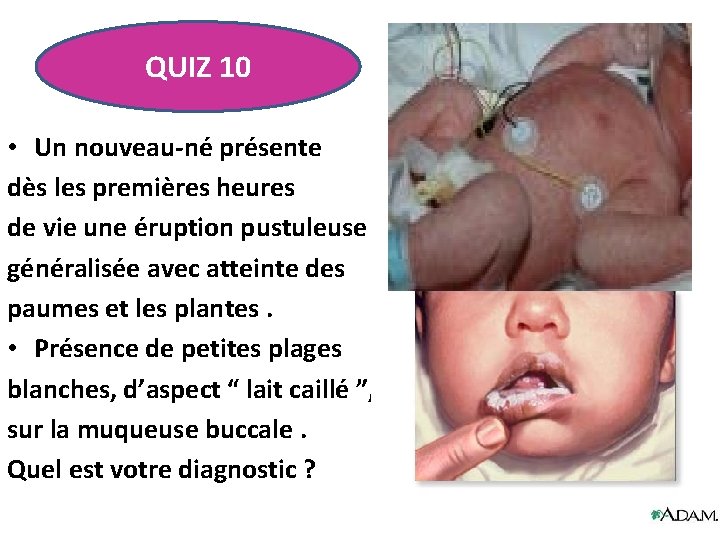 QUIZ 10 • Un nouveau-né présente dès les premières heures de vie une éruption