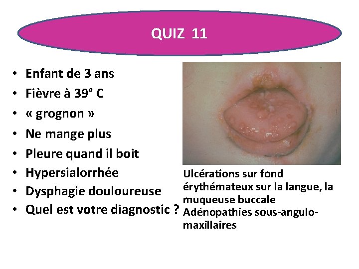 QUIZ 11 • • Enfant de 3 ans Fièvre à 39° C « grognon