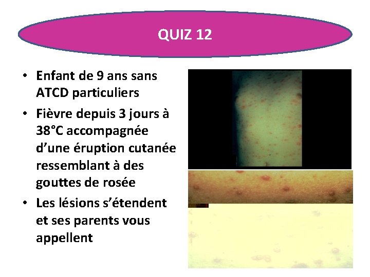 QUIZ 12 • Enfant de 9 ans sans ATCD particuliers • Fièvre depuis 3