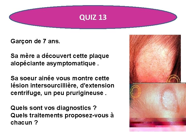 QUIZ 13 Garçon de 7 ans. Sa mère a découvert cette plaque alopéciante asymptomatique.