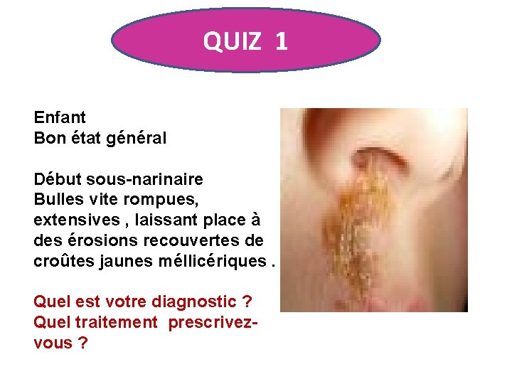 QUIZ 1 Enfant Bon état général Début sous-narinaire Bulles vite rompues, extensives , laissant