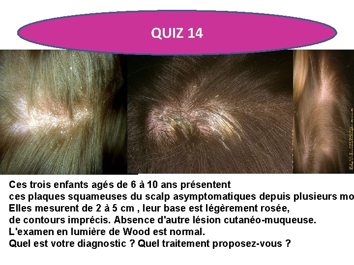 QUIZ 14 Ces trois enfants agés de 6 à 10 ans présentent ces plaques