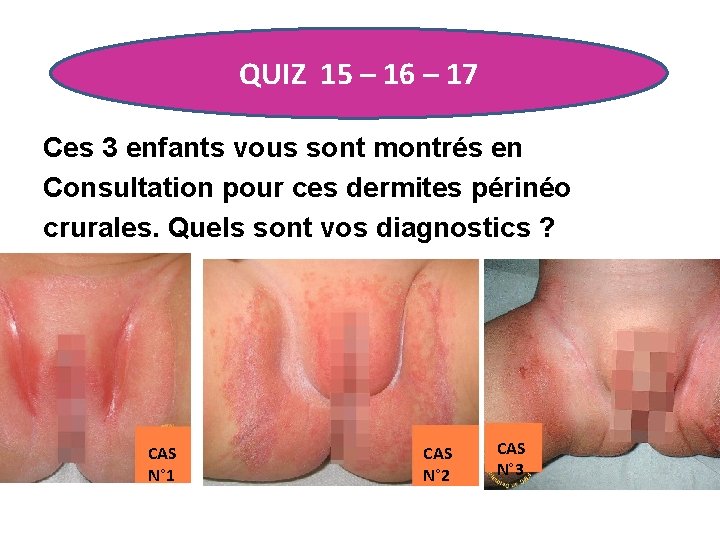 QUIZ 15 – 16 – 17 Ces 3 enfants vous sont montrés en Consultation