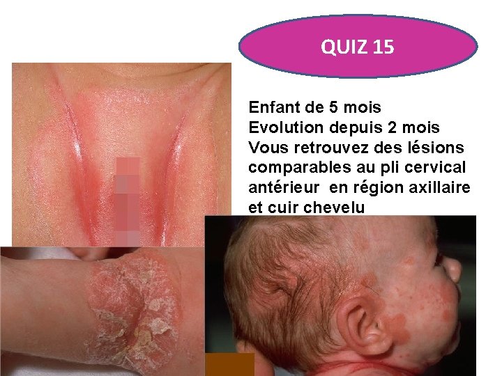 QUIZ 15 Enfant de 5 mois Evolution depuis 2 mois Vous retrouvez des lésions