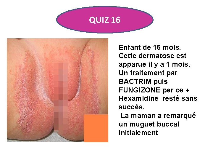 QUIZ 16 Enfant de 16 mois. Cette dermatose est apparue il y a 1