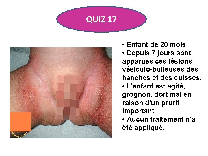 QUIZ 17 • Enfant de 20 mois • Depuis 7 jours sont apparues ces