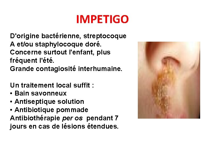 IMPETIGO D'origine bactérienne, streptocoque A et/ou staphylocoque doré. Concerne surtout l'enfant, plus fréquent l'été.