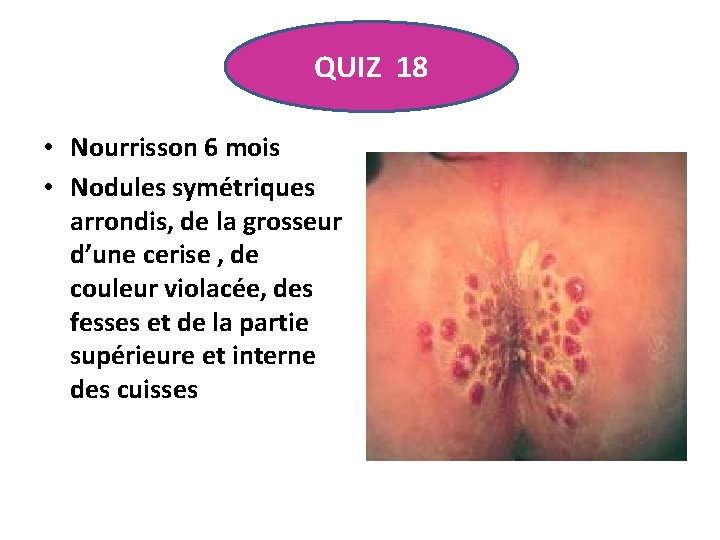 QUIZ 18 • Nourrisson 6 mois • Nodules symétriques arrondis, de la grosseur d’une