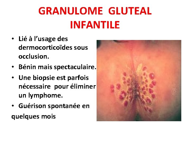 GRANULOME GLUTEAL INFANTILE • Lié à l’usage des dermocorticoïdes sous occlusion. • Bénin mais