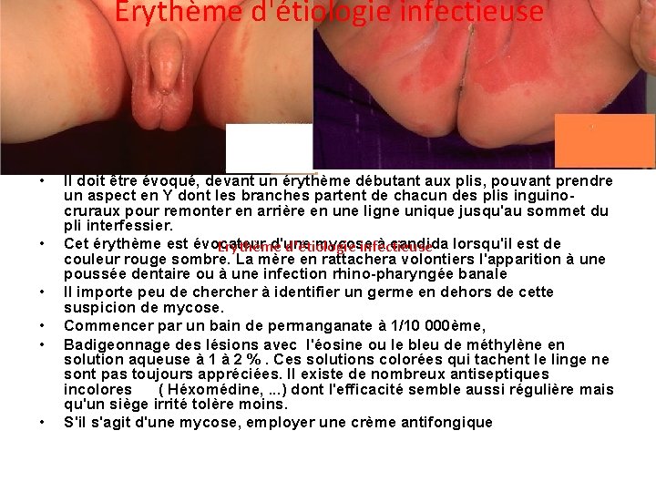 Erythème d'étiologie infectieuse • • • Il doit être évoqué, devant un érythème débutant