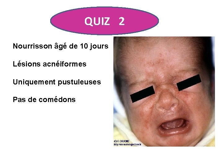 QUIZ 2 Nourrisson âgé de 10 jours Lésions acnéiformes Uniquement pustuleuses Pas de comédons