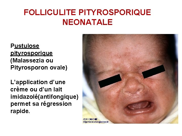 FOLLICULITE PITYROSPORIQUE NEONATALE Pustulose pityrosporique (Malassezia ou Pityrosporon ovale) L’application d’une crème ou d’un