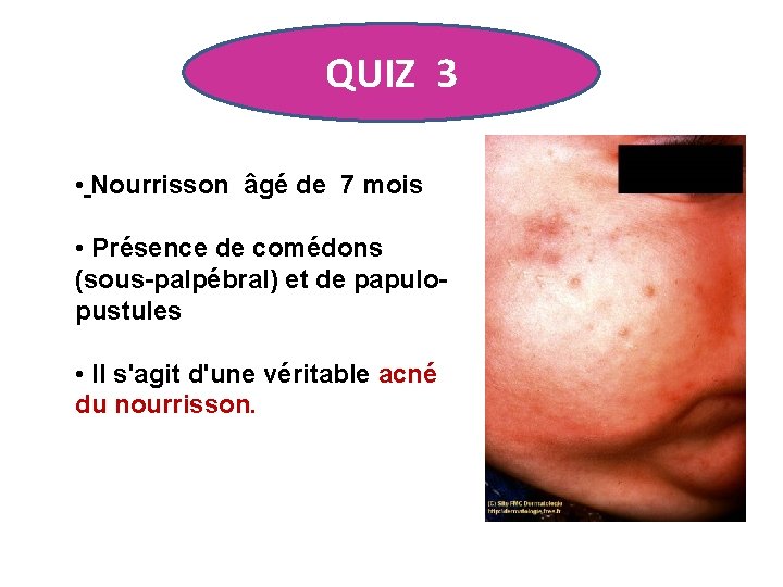 QUIZ 3 • Nourrisson âgé de 7 mois • Présence de comédons (sous-palpébral) et