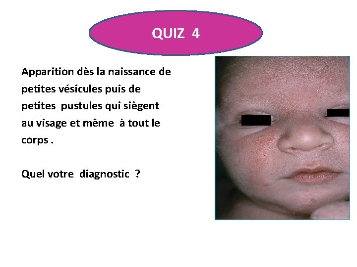 QUIZ 4 Apparition dès la naissance de petites vésicules puis de petites pustules qui