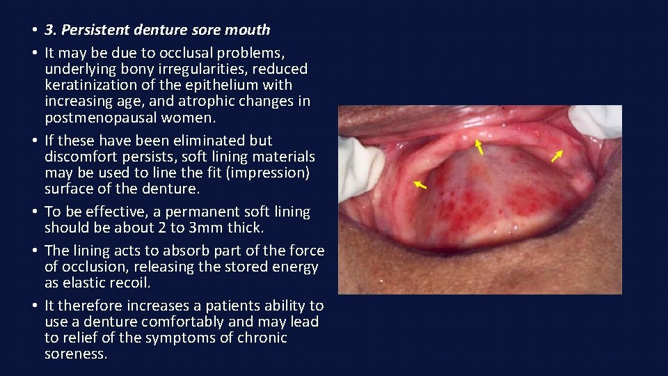  • 3. Persistent denture sore mouth • It may be due to occlusal