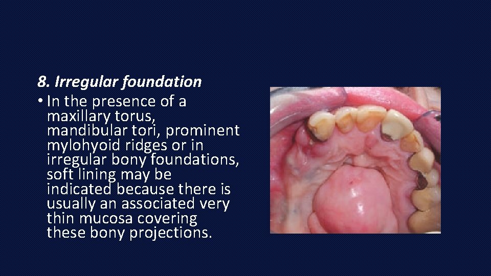 8. Irregular foundation • In the presence of a maxillary torus, mandibular tori, prominent