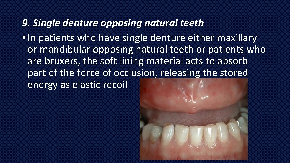 9. Single denture opposing natural teeth • In patients who have single denture either