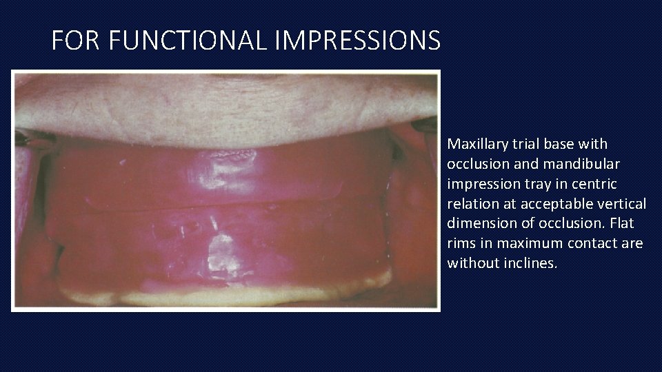 FOR FUNCTIONAL IMPRESSIONS Maxillary trial base with occlusion and mandibular impression tray in centric