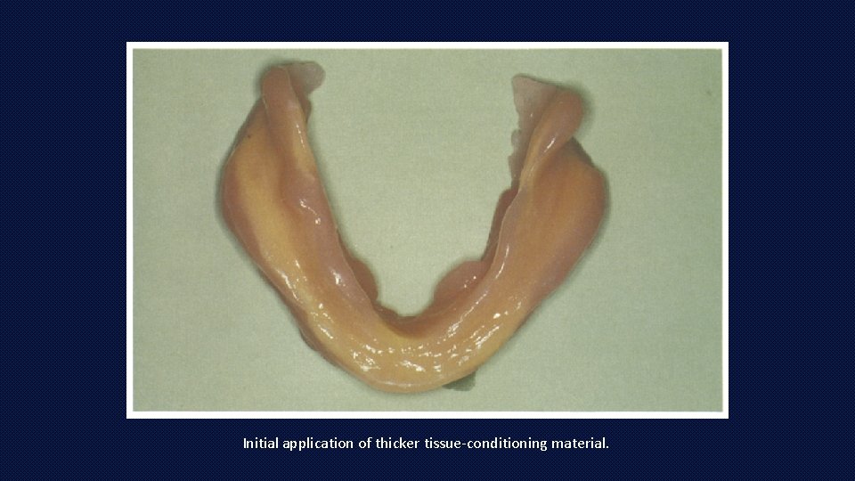 Initial application of thicker tissue-conditioning material. 