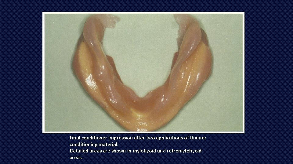 Final conditioner impression after two applications of thinner conditioning material. Detailed areas are shown