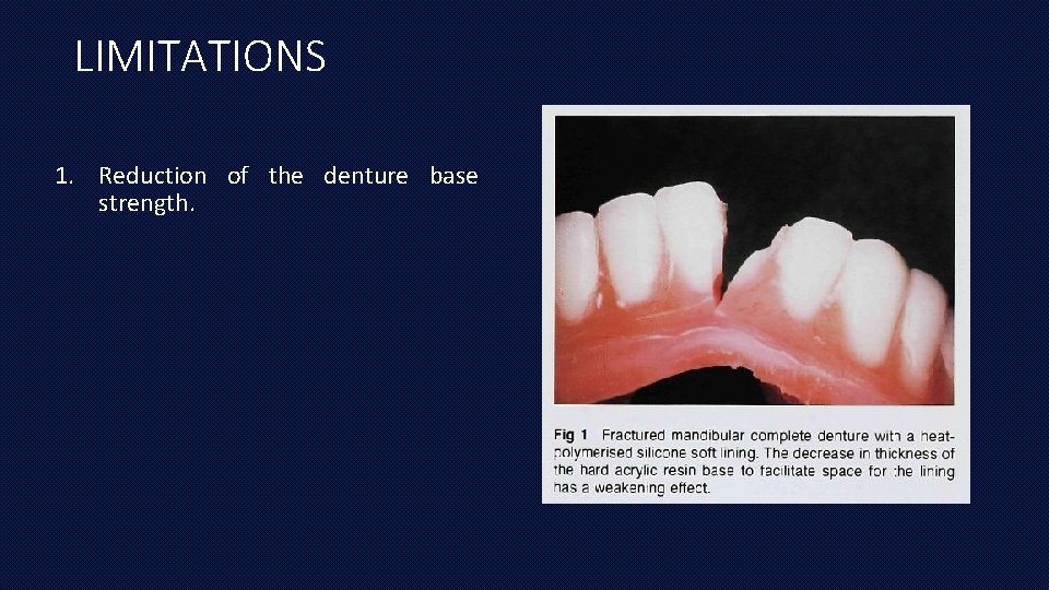 LIMITATIONS 1. Reduction of the denture base strength. 