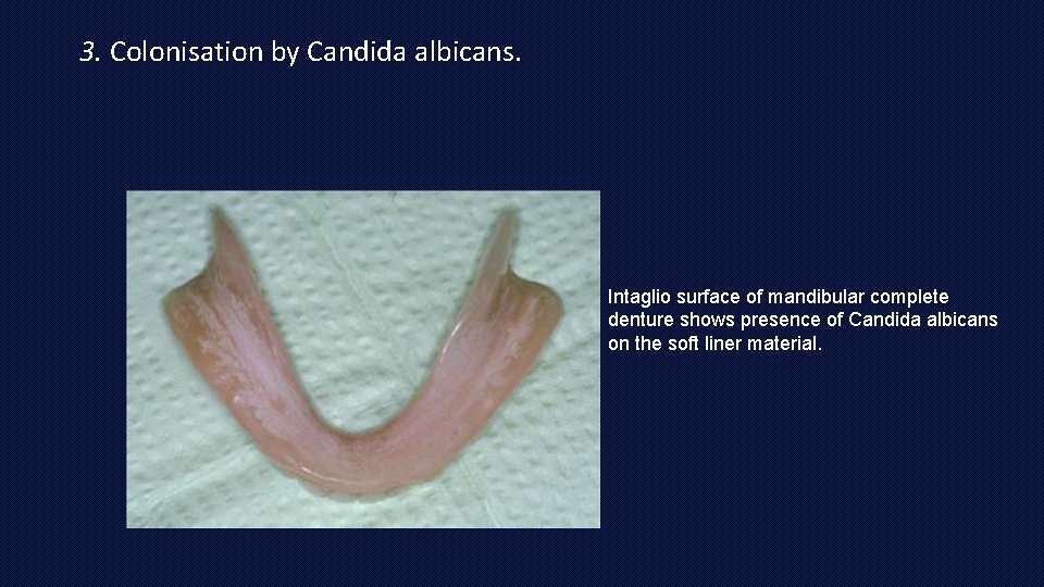 3. Colonisation by Candida albicans. Intaglio surface of mandibular complete denture shows presence of