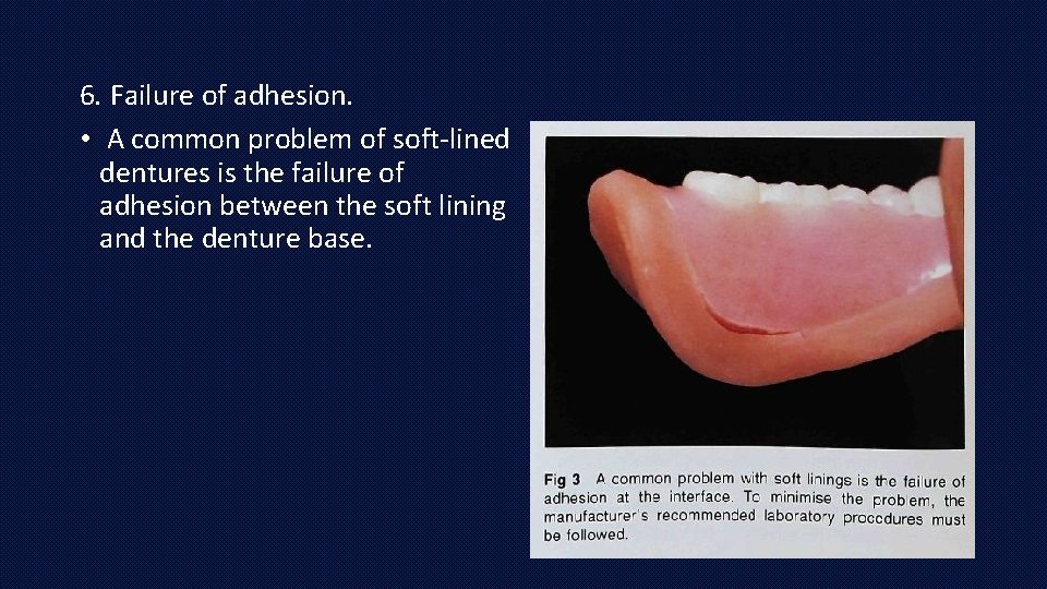 6. Failure of adhesion. • A common problem of soft-lined dentures is the failure