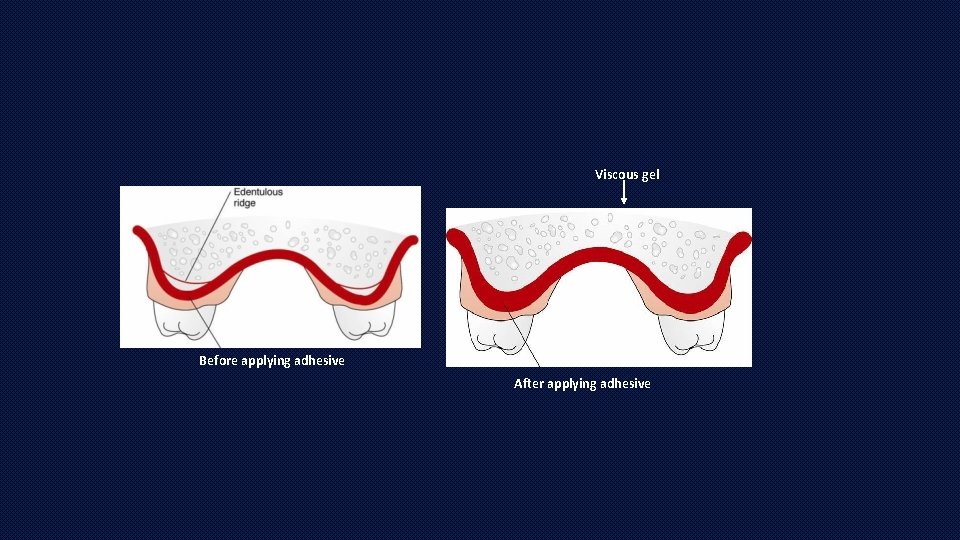 Viscous gel Before applying adhesive After applying adhesive 