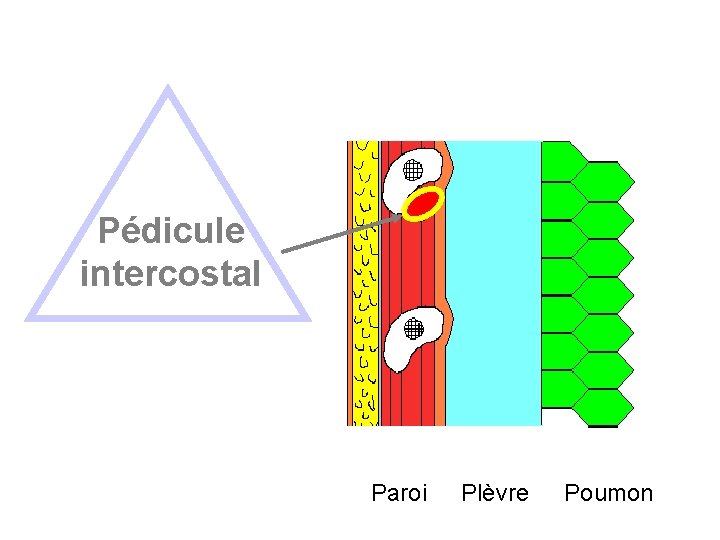 Pédicule intercostal Paroi Plèvre Poumon 