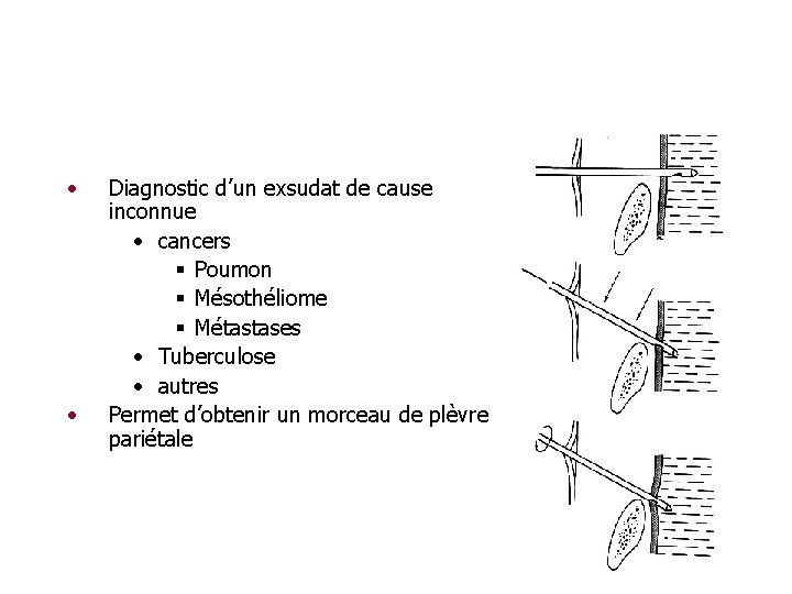  • • Diagnostic d’un exsudat de cause inconnue • cancers § Poumon §