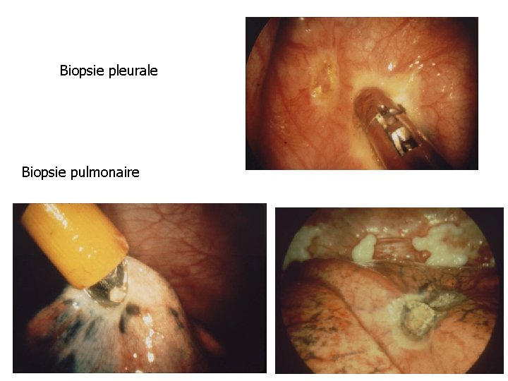 Biopsie pleurale Biopsie pulmonaire 