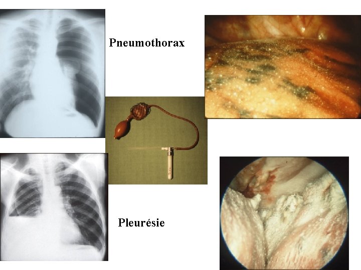 Pneumothorax Pleurésie 