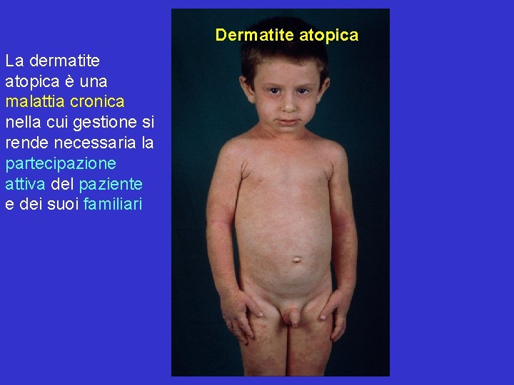 Dermatite atopica La dermatite atopica è una malattia cronica nella cui gestione si rende