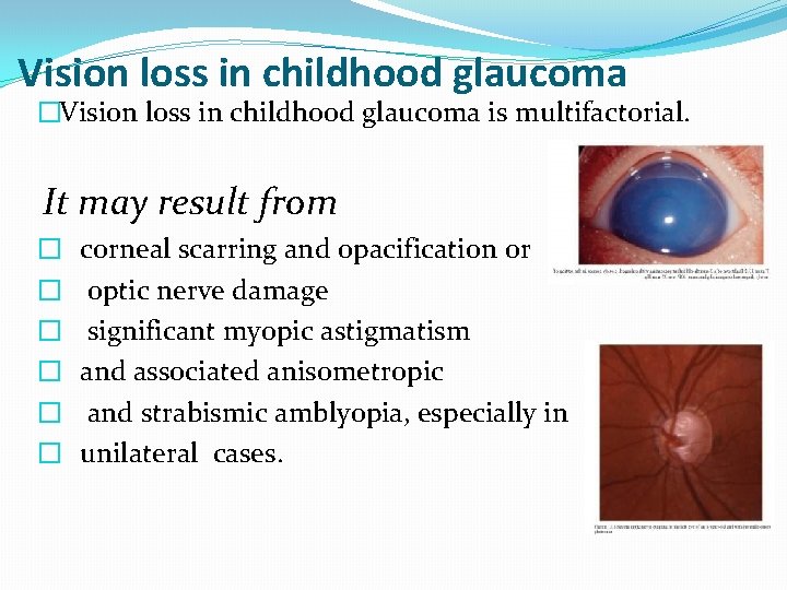 Vision loss in childhood glaucoma �Vision loss in childhood glaucoma is multifactorial. It may