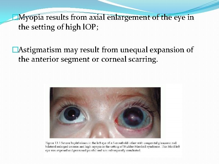 �Myopia results from axial enlargement of the eye in the setting of high l.