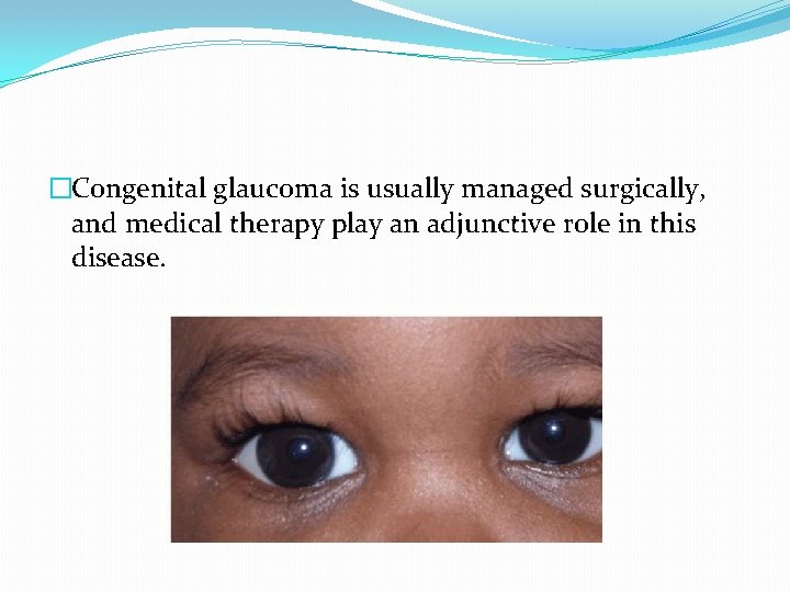 �Congenital glaucoma is usually managed surgically, and medical therapy play an adjunctive role in