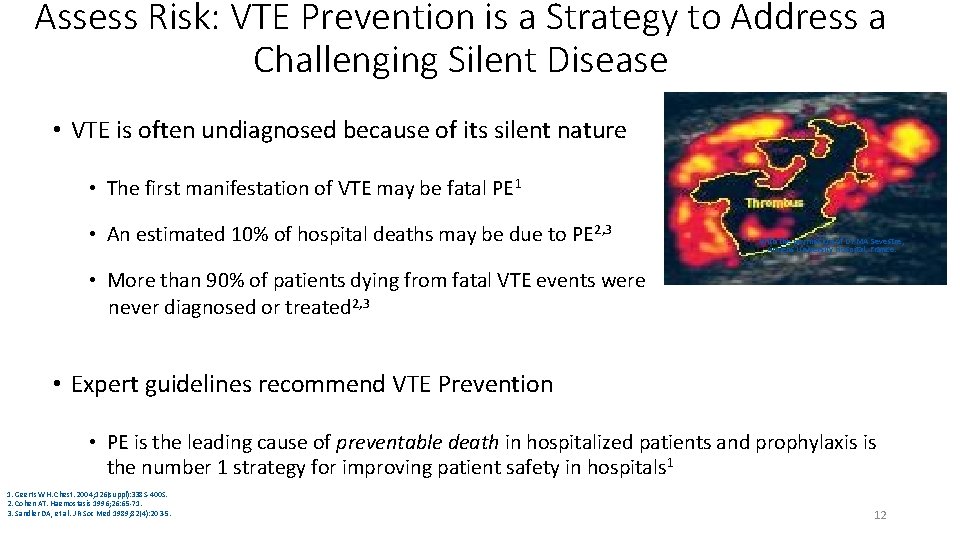 Assess Risk: VTE Prevention is a Strategy to Address a Challenging Silent Disease •