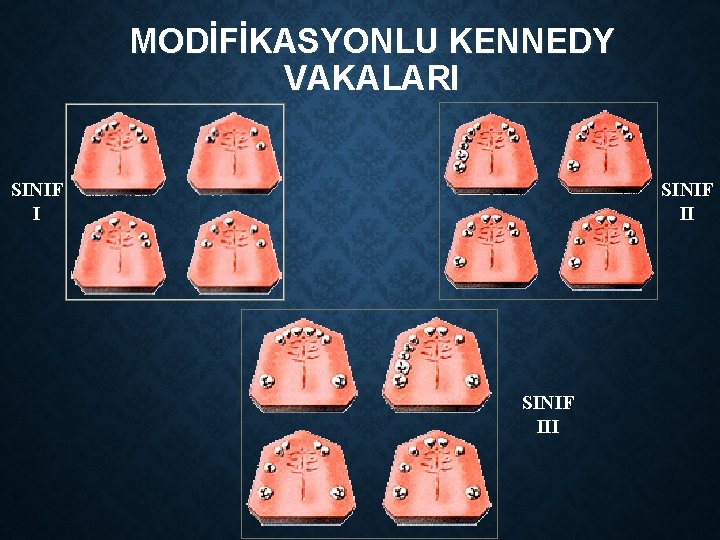 MODİFİKASYONLU KENNEDY VAKALARI SINIF III 