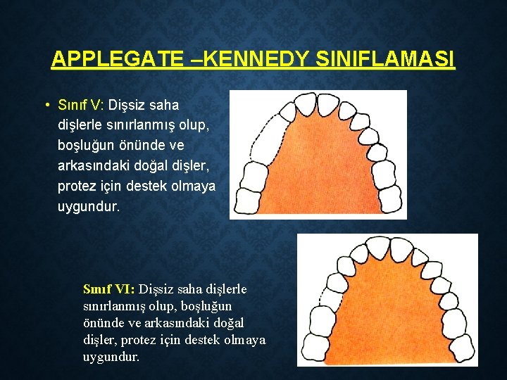 APPLEGATE –KENNEDY SINIFLAMASI • Sınıf V: Dişsiz saha dişlerle sınırlanmış olup, boşluğun önünde ve