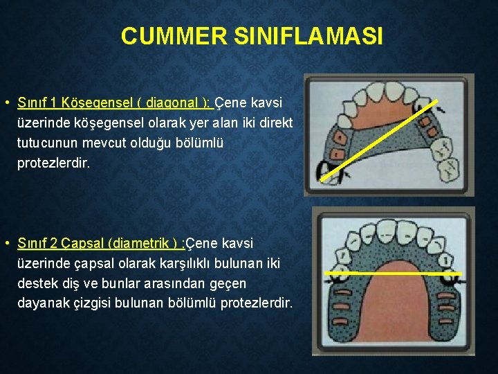 CUMMER SINIFLAMASI • Sınıf 1 Köşegensel ( diagonal ): Çene kavsi üzerinde köşegensel olarak