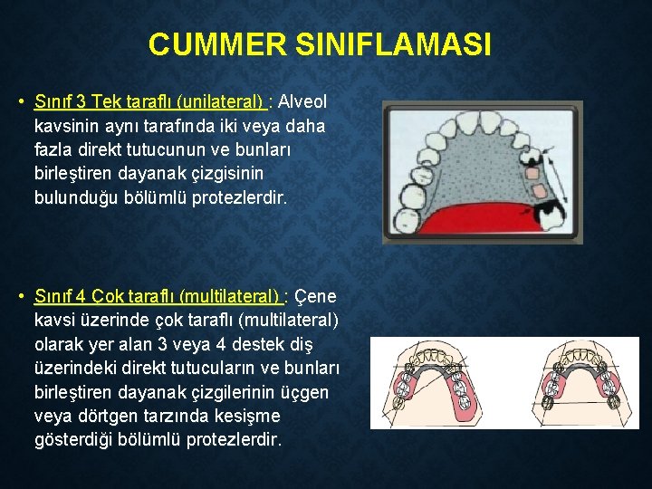 CUMMER SINIFLAMASI • Sınıf 3 Tek taraflı (unilateral) : Alveol kavsinin aynı tarafında iki