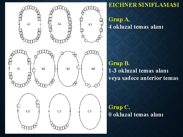 EICHNER SINIFLAMASI Grup A. 4 okluzal temas alanı Grup B. 1 -3 okluzal temas