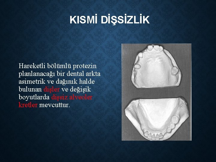 KISMİ DİŞSİZLİK Hareketli bölümlü protezin planlanacağı bir dental arkta asimetrik ve dağınık halde bulunan