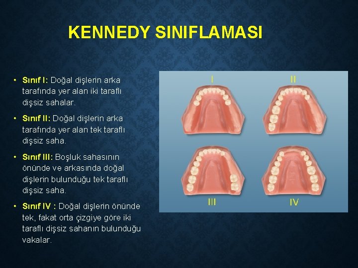 KENNEDY SINIFLAMASI • Sınıf I: Doğal dişlerin arka tarafında yer alan iki taraflı dişsiz