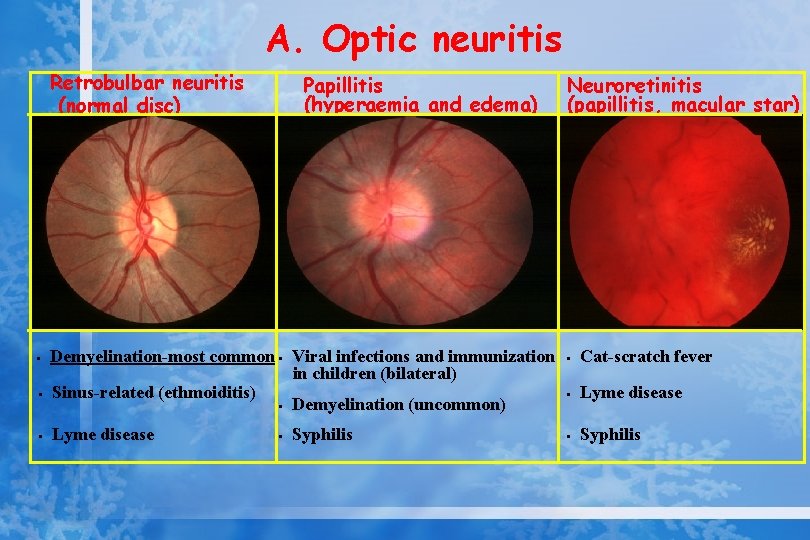 A. Optic neuritis Retrobulbar neuritis (normal disc) • • • Papillitis (hyperaemia and edema)