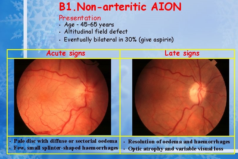 B 1. Non-arteritic AION Presentation • • • Age - 45 -65 years Altitudinal