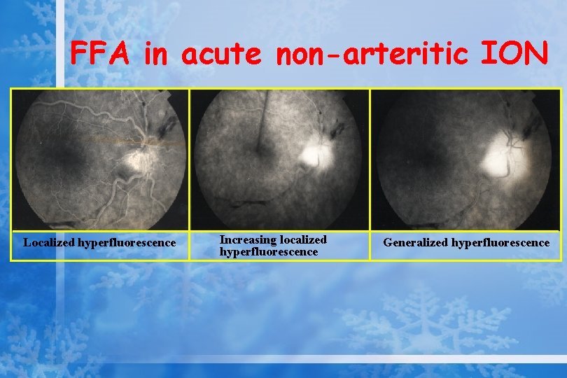 FFA in acute non-arteritic ION Localized hyperfluorescence Increasing localized hyperfluorescence Generalized hyperfluorescence 