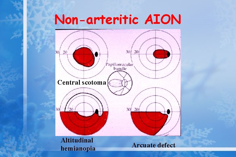 Non-arteritic AION Central scotoma Altitudinal hemianopia Arcuate defect 