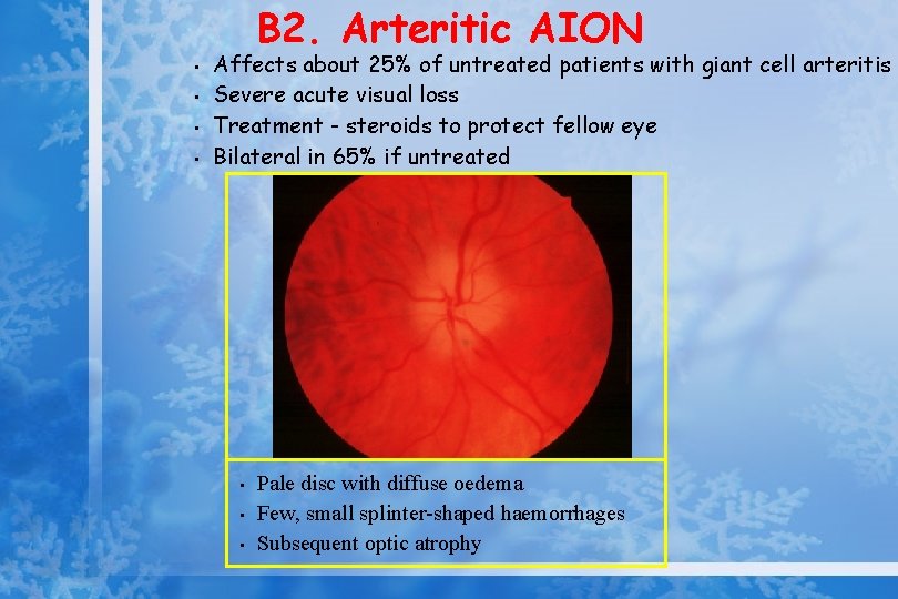 B 2. Arteritic AION • • Affects about 25% of untreated patients with giant