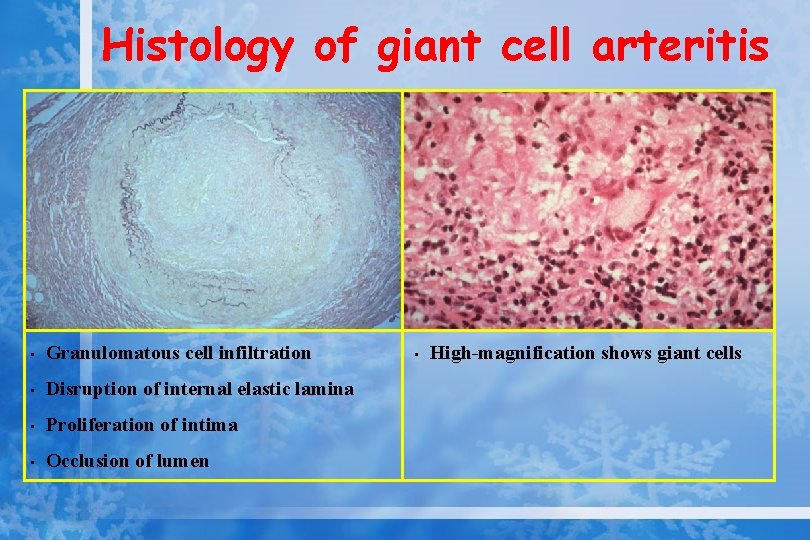 Histology of giant cell arteritis • Granulomatous cell infiltration • Disruption of internal elastic